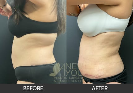 Tummy Tuck Gallery