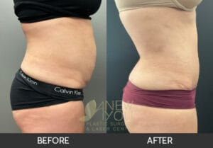 Tummy Tuck Before and After, Chicago, IL