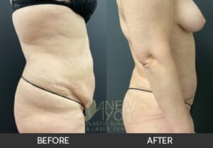 Tummy Tuck Before and After, Chicago, IL