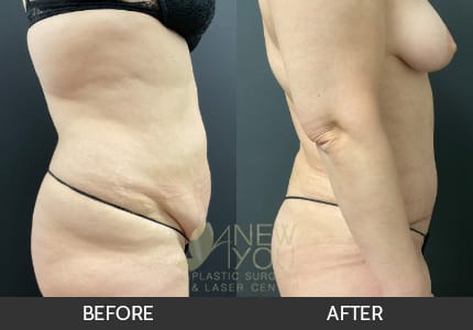 Tummy Tuck Gallery