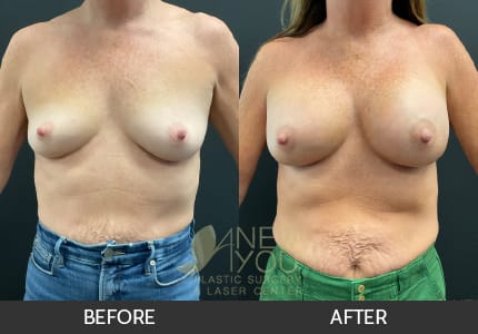 Breast Augmentation Gallery