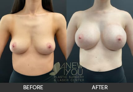 Breast Augmentation Gallery