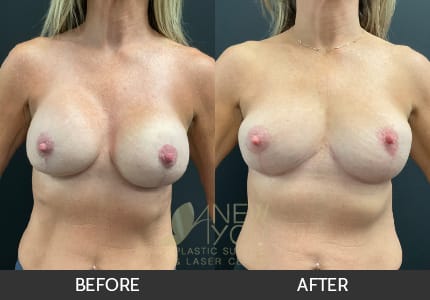 Breast Revision Gallery