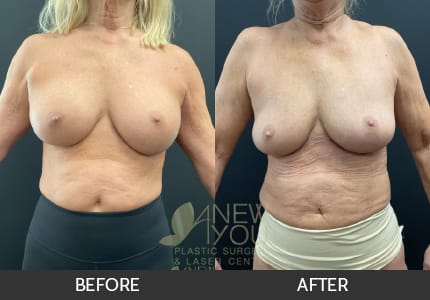 Breast Revision Gallery