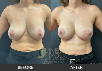Breast Revision Gallery