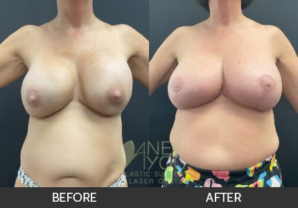 Breast Revision Gallery
