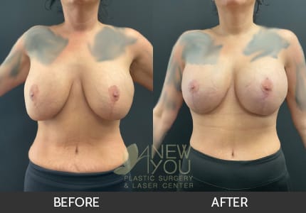 Breast Revision Gallery