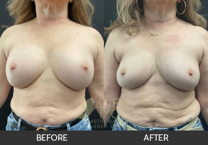Breast Revision Gallery