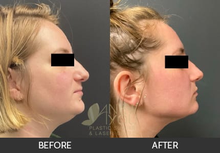 Liposuction Gallery
