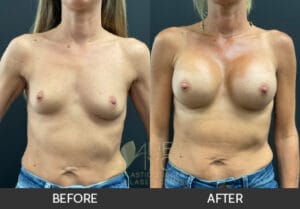 Breast Augmentation Before and After, Chicago, IL