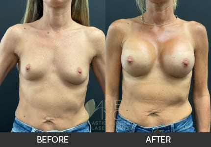 Breast Augmentation Gallery