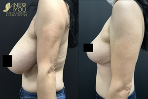 The Transformative Impact of Breast Reduction Surgery Before and After Results by A New You