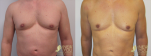 Understanding Gynecomastia and Exploring Treatment Options