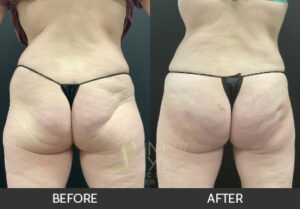 Brazilian Butt Lift Before and After, Chicago, IL