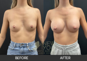 Breast Augmentation Before and After, Chicago, IL