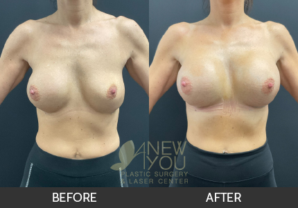 Breast Revision Gallery