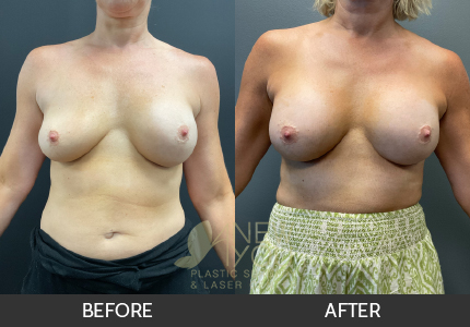 Breast Revision Gallery