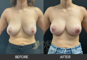 Breast Revision Before and After, Chicago, IL