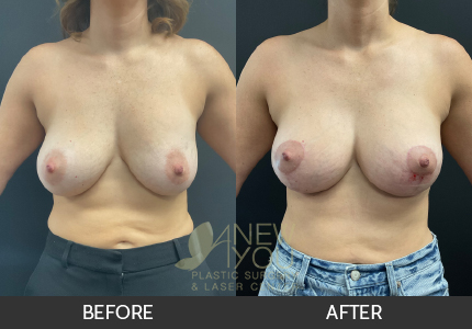 Breast Revision Gallery