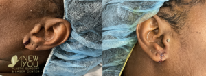 What is a Split Earlobe?