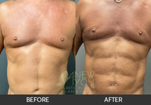 Male Liposuction Before and After, Chicago, IL