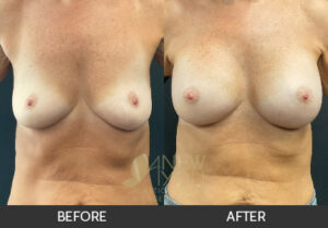 Breast Augmentation Before and After, Chicago, IL