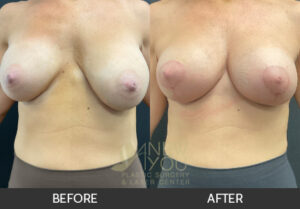 Breast Revision Before and After, Chicago, IL