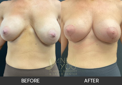 Breast Revision Gallery
