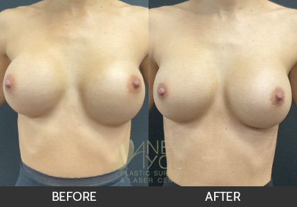 Breast Revision Gallery