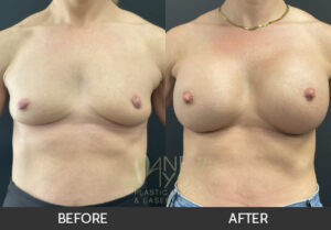 Breast Augmentation Before and After, Chicago, IL