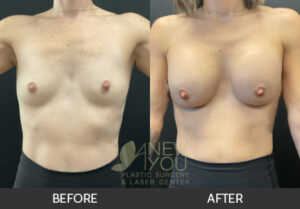 Breast Augmentation Before and After, Chicago, IL