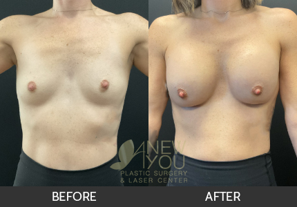 Breast Augmentation Gallery