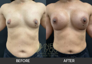 Breast Augmentation Before and After, Chicago, IL