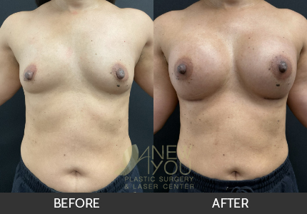 Breast Augmentation Gallery