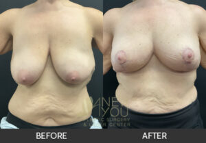Breast Lift Before and After, Chicago, IL