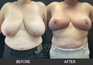 Breast Reduction Before and After, Chicago, IL