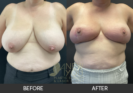 Breast Reduction Gallery