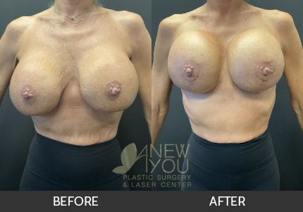 Breast Revision Gallery