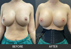Breast Revision Before and After, Chicago, IL