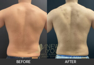 Male Liposuction Before and After, Chicago, IL