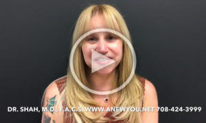 Brow Lift, Facelift, Fat Grafting Patient Testimonial Video