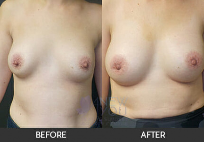 Breast Revision Gallery