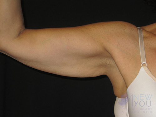 Arm Lift Before Arm Lift Before - Chicago, IL