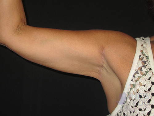 Arm Lift After Arm Lift After - Chicago, IL