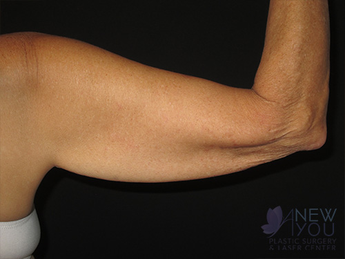 Arm Lift Before Arm Lift Before - Chicago, IL