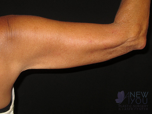Arm Lift After Arm Lift After - Chicago, IL