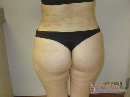 Brazilian Butt Lift After Brazilian Butt Lift After - Chicago, IL