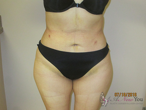 Brazilian Butt Lift After Brazilian Butt Lift After - Chicago, IL