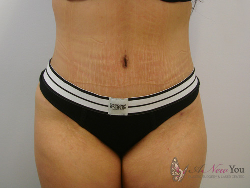 Brazilian Butt Lift After Brazilian Butt Lift After - Chicago, IL