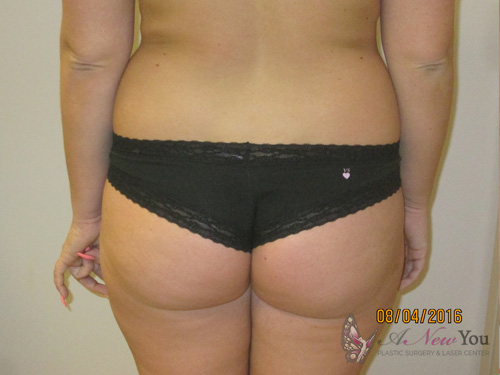 Brazilian Butt Lift Before Brazilian Butt Lift Before - Chicago, IL